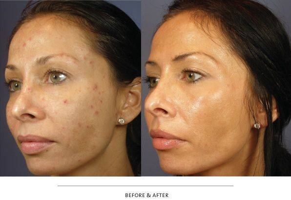 VI PEEL Treatment by Savvychicmedspa