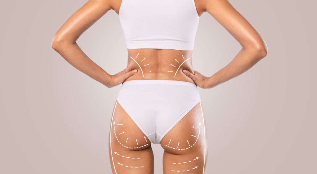 Sculptra Butt Lift in Spring, Texas | Savvy Chic Medspa