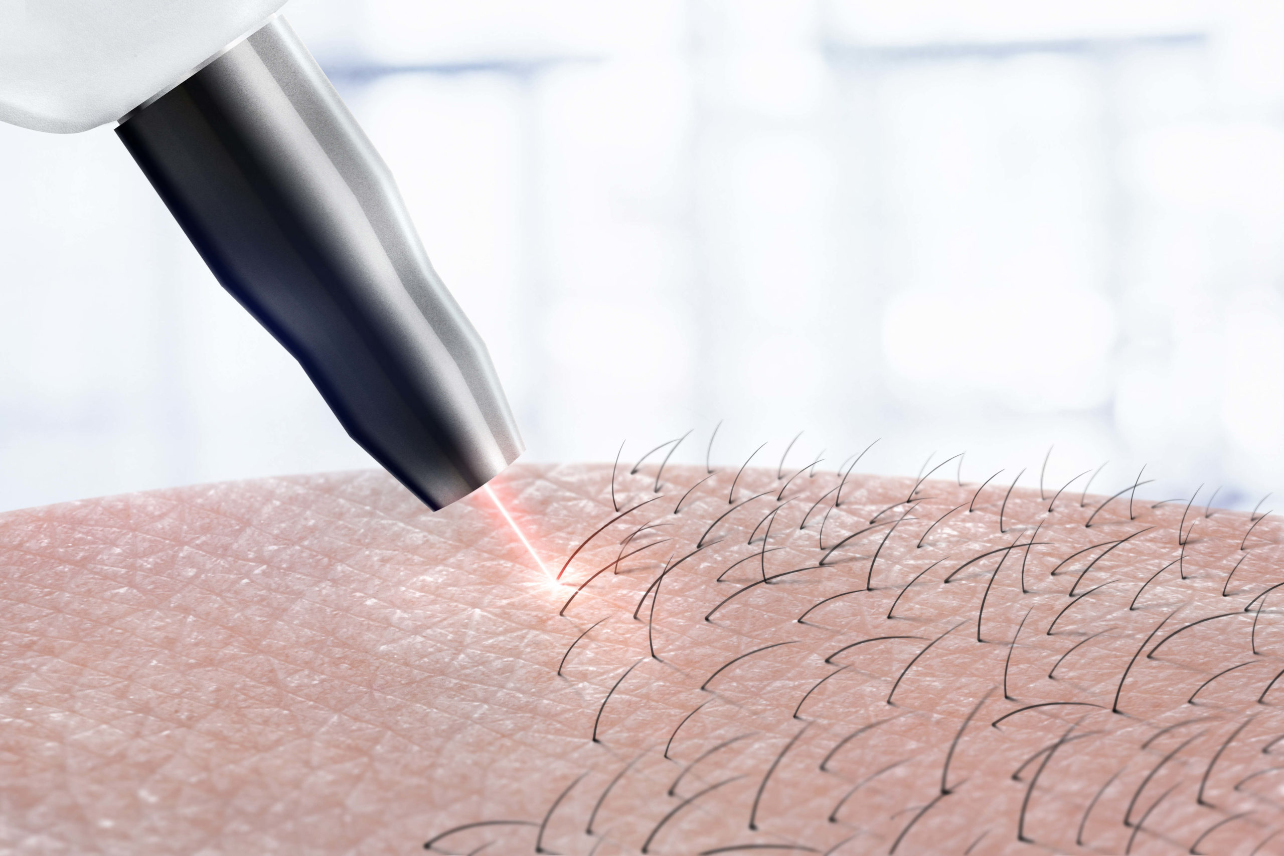 What are the Benefits of Laser Hair Removal Treatment?