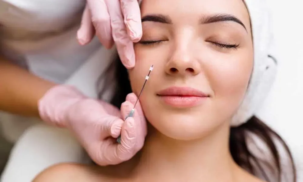 PDO Max Thread Lift in Spring, TX by Savvy Chic Medspa