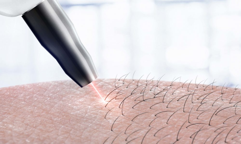 What are the Benefits of Laser Hair Removal Treatment?